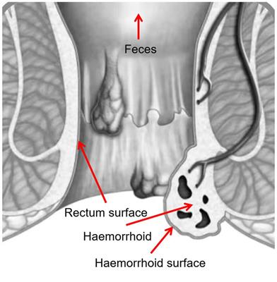 The microbiomic signature of hemorrhoids and comparison with associated microbiomes